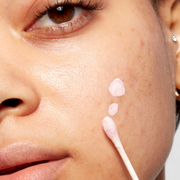Acne & Blemishes